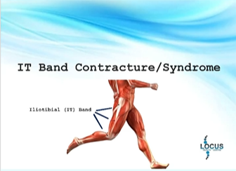 ILIOTIBIAL BAND CONTRACTURE - Innovative Therapy Canada